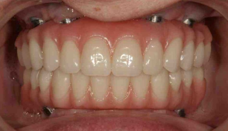 How to care for all on 4 dental implants