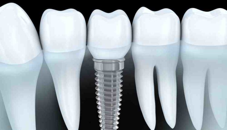 How to care for my dental implants