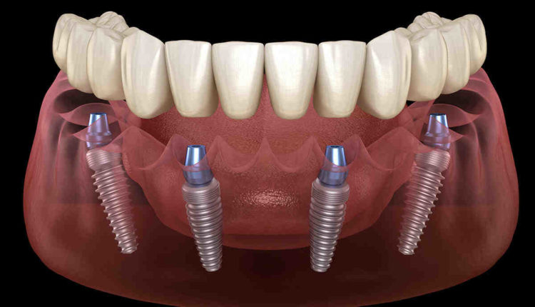 How to care for your dental implants