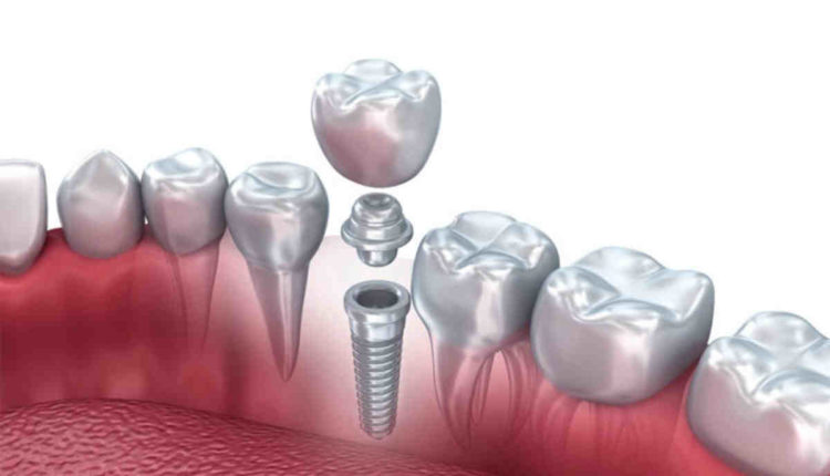 How to get dental implants covered