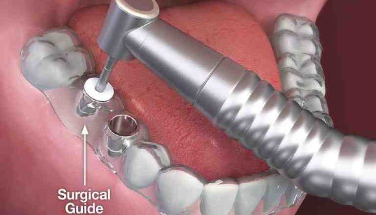 How to prepare for dental implant surgery