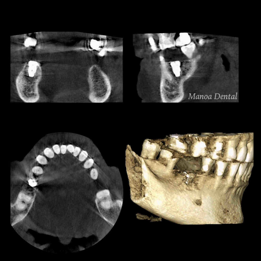 How to tell what type of dental implant on xray Dental News Network