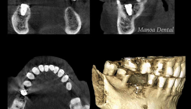 How to tell what type of dental implant on x-ray