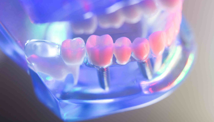 How.much are dental implants