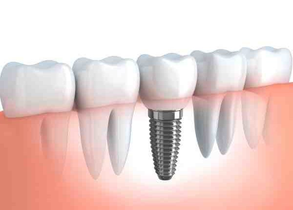 Is it better to get a dental bridge or 1 implant and 2 crowns