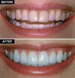 Is it cheaper to get crowns or veneers?