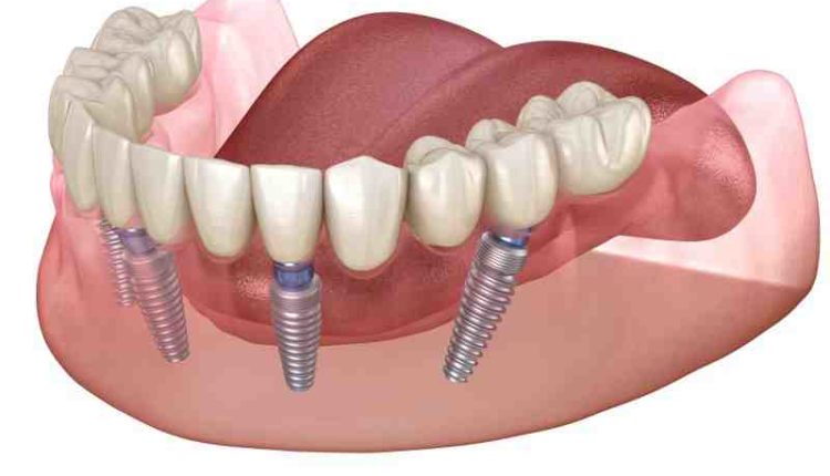 Is it really possible to get dental implants in a day