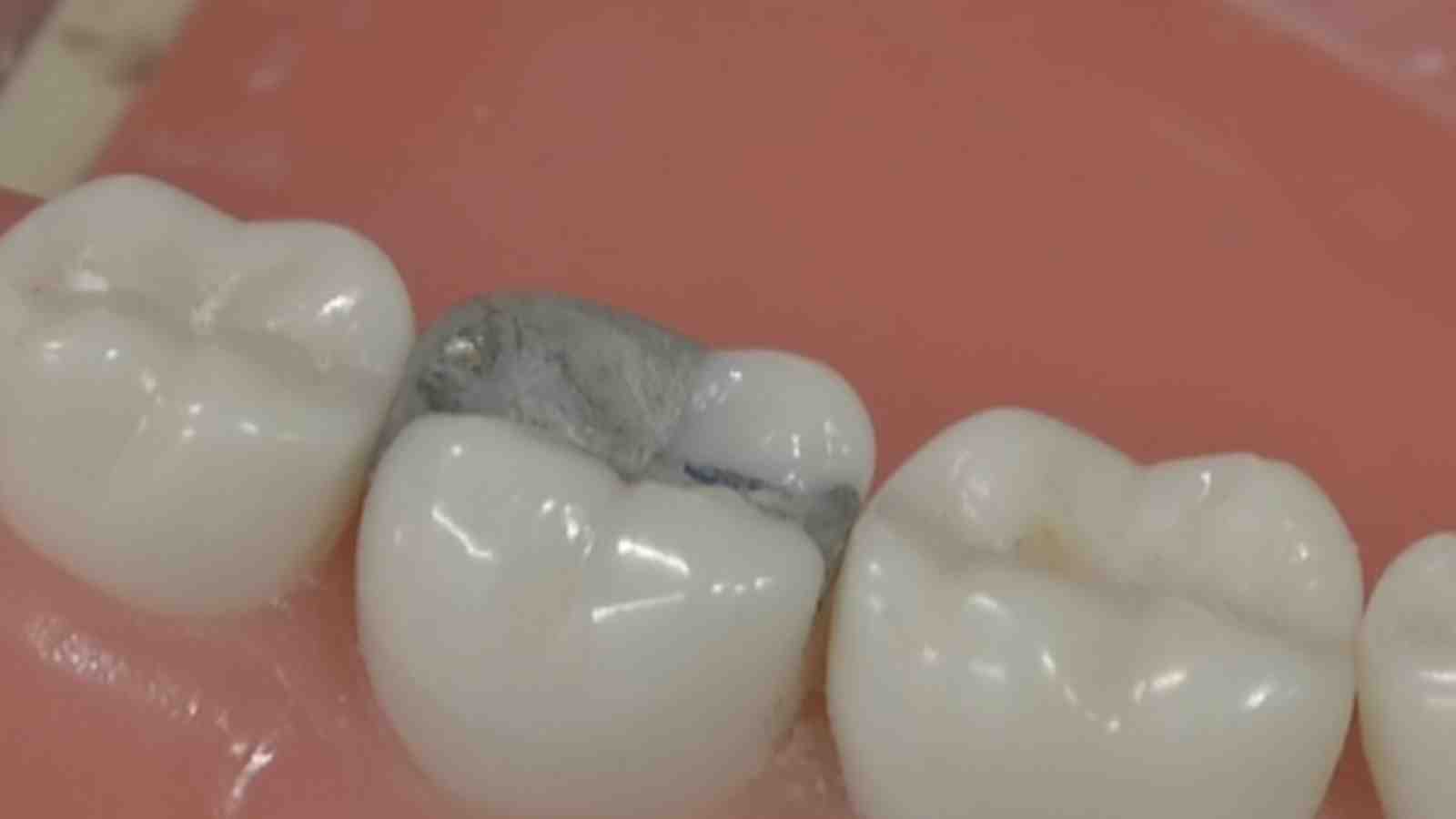 Can i have an mri with a dental implant Dental News Network