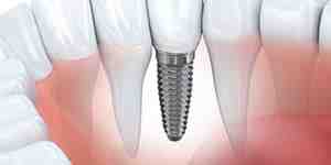 Is it safe to get dental implants in Mexico?
