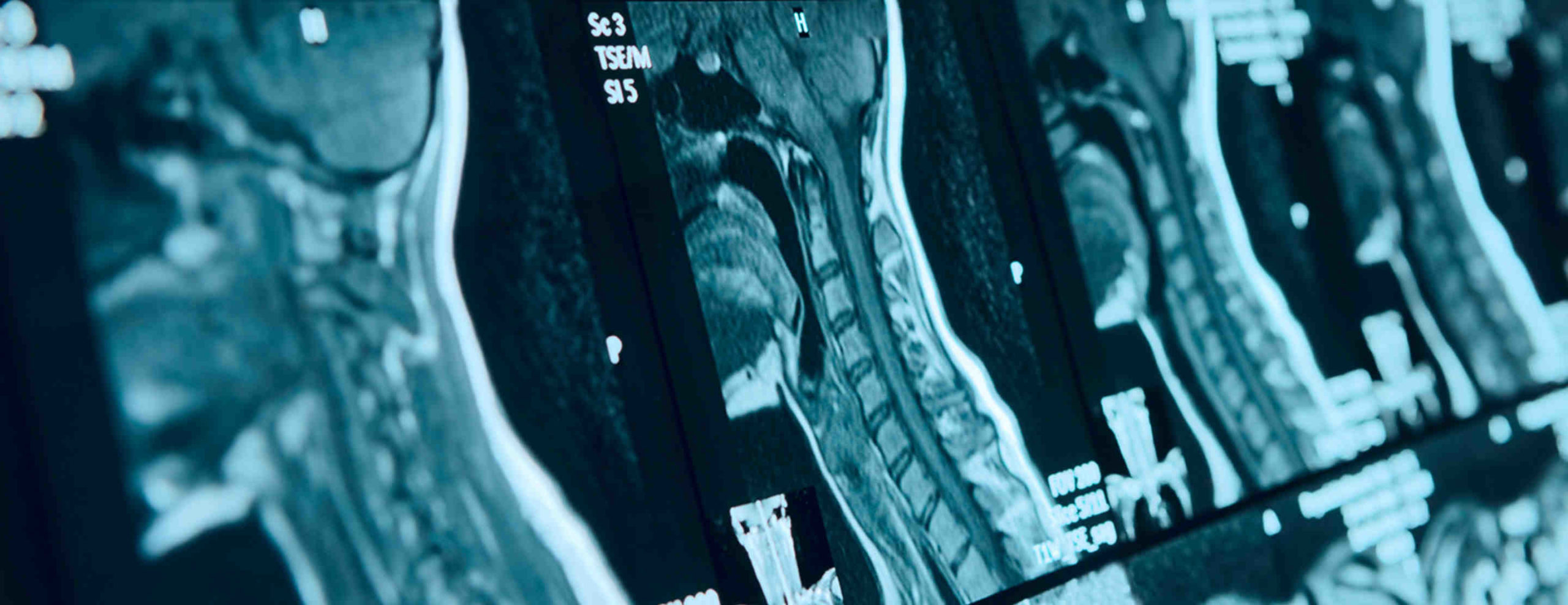 Can you have mri with dental implants Dental News Network