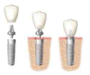 Is titanium good for implants?