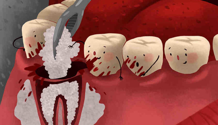 Should you take calcium supplement for dental implant