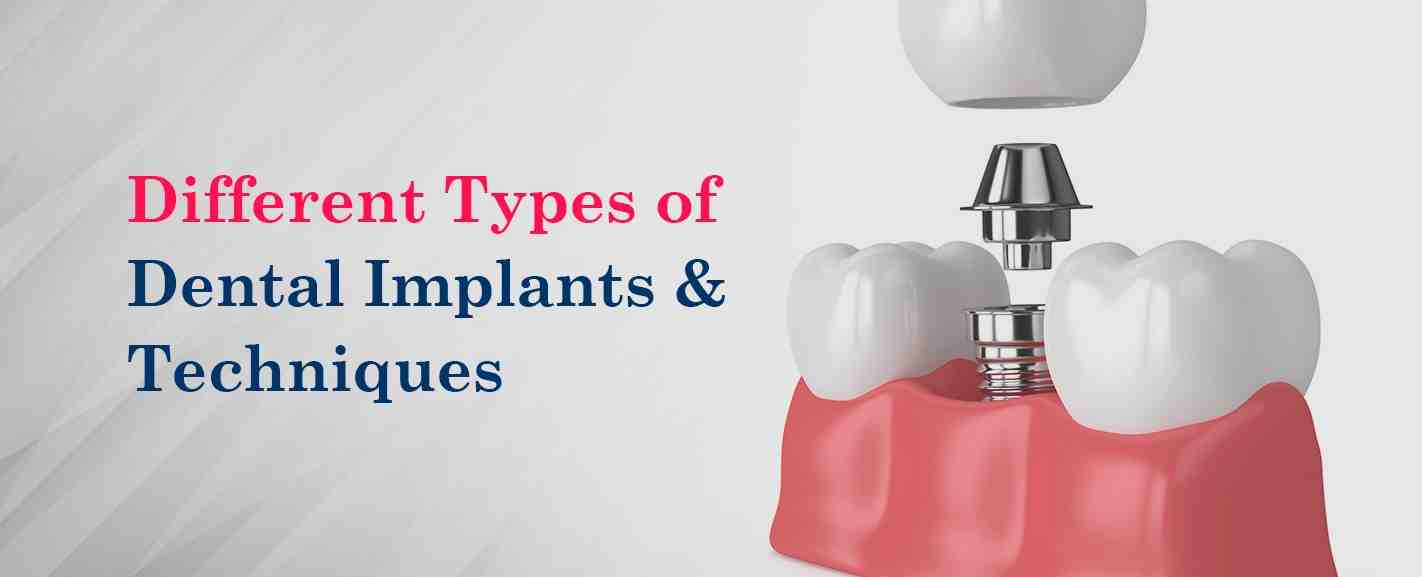 What are Hiossen implants?
