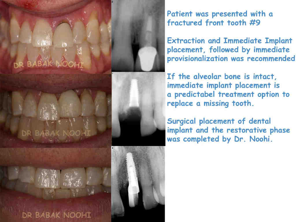 What are the 3 stages of dental implants?