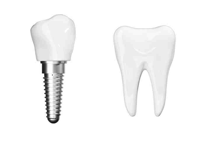 What are the side effects of titanium implants?