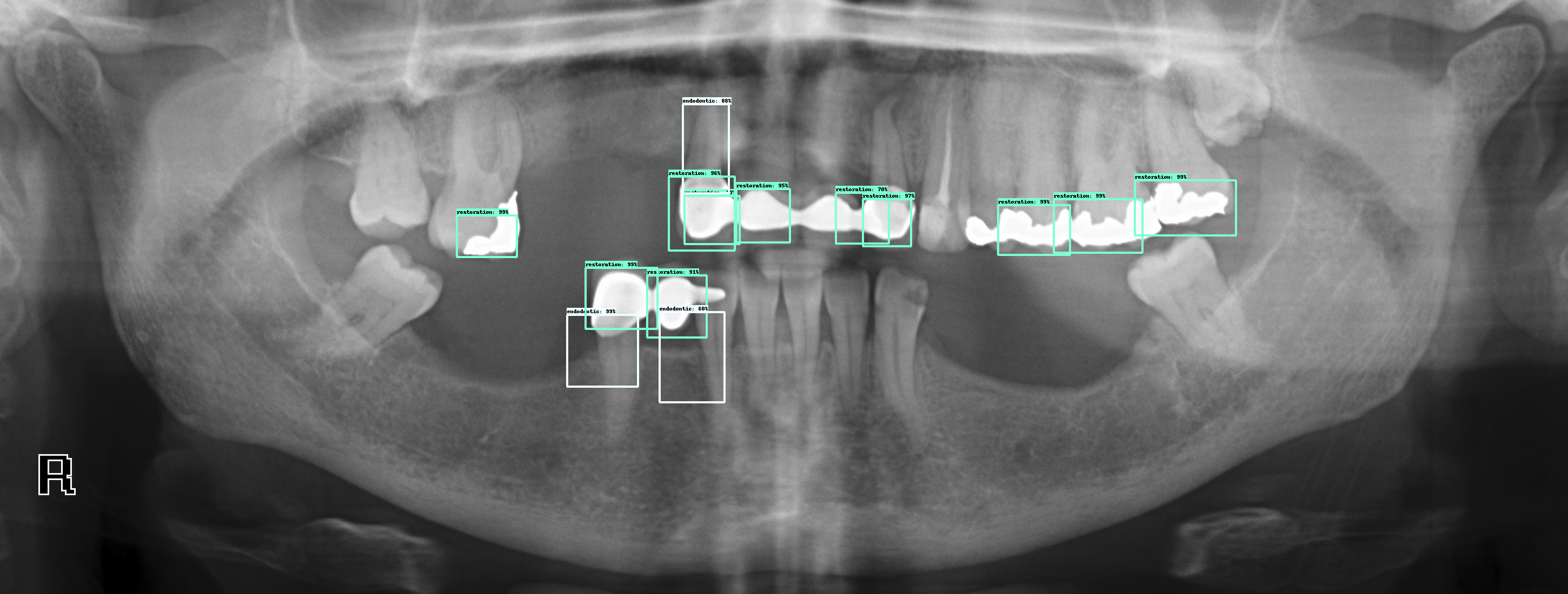 How to tell what type of dental implant on xray Dental News Network