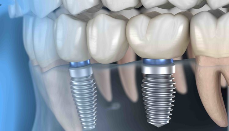 What can be done to prepare for dental implants