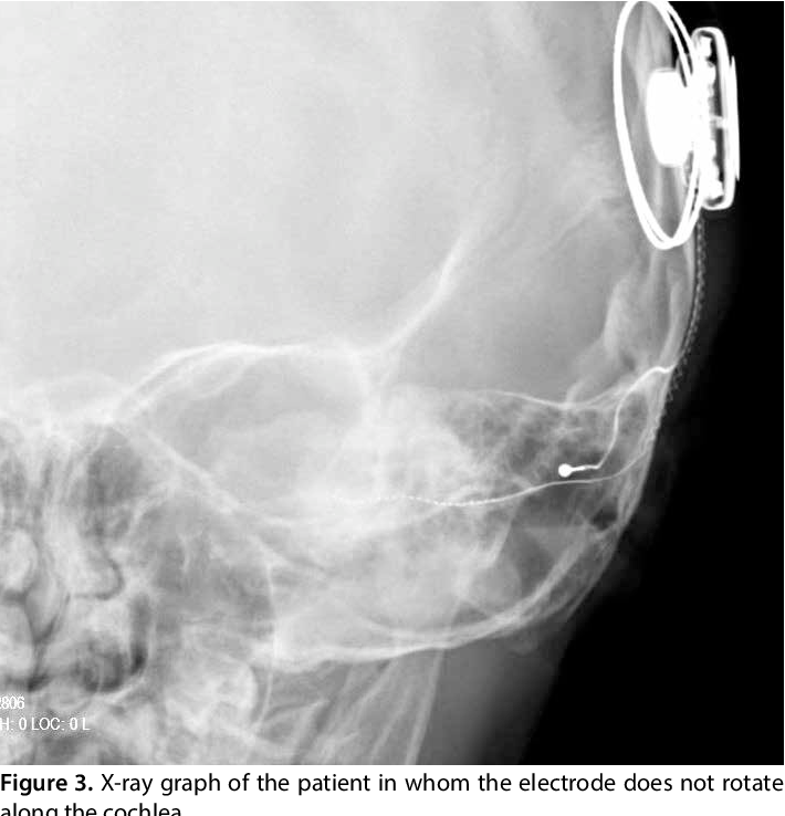 What can't you do with a cochlear implant?