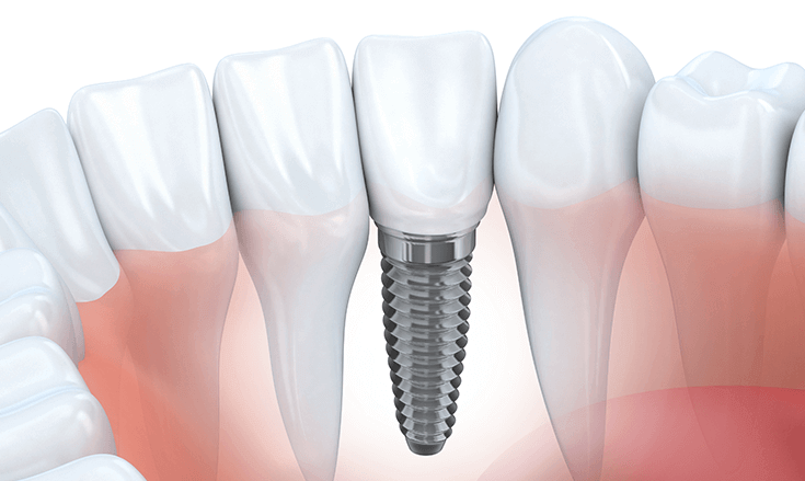 What career studies dental implants?