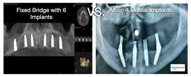What category does dental implant fall under?