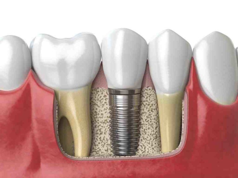 Can I Use Hsa For Dental Implants