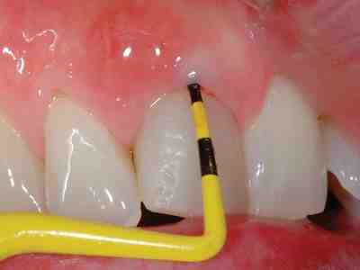 What do I do if my dental implant is infected?