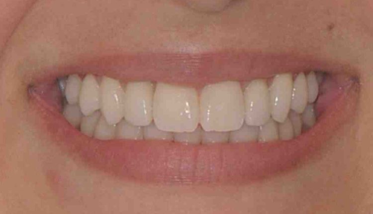 What do a full upper dental implants look like