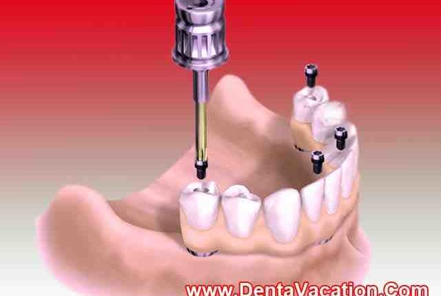 What do dental implants cost in mexico