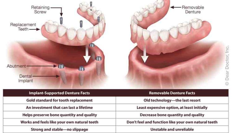 What does it feel like to have dental implants