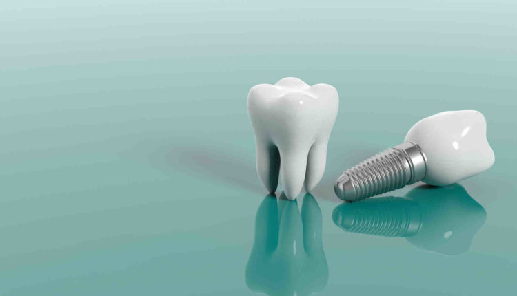 What effects the longevity of dental implants
