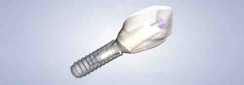 What federal dental insurance covers implants?