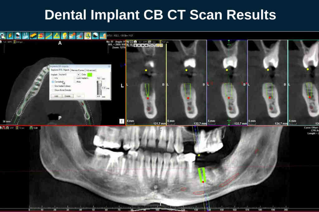 Can you have mri with dental implants Dental News Network