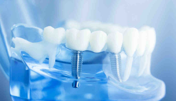 What insurance should i get if im planning to get dental implants