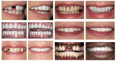 What is a reasonable price for dental implants?