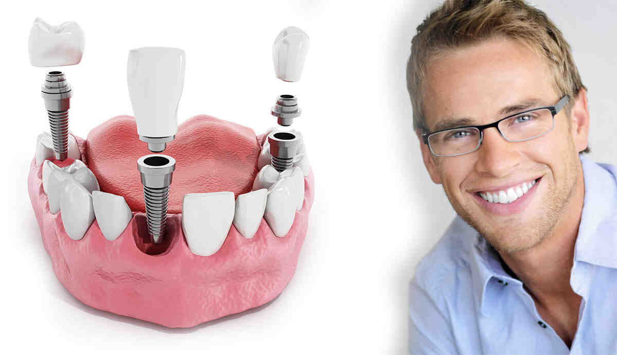 Who in houston texas has the cheapest price on dental implants Dental
