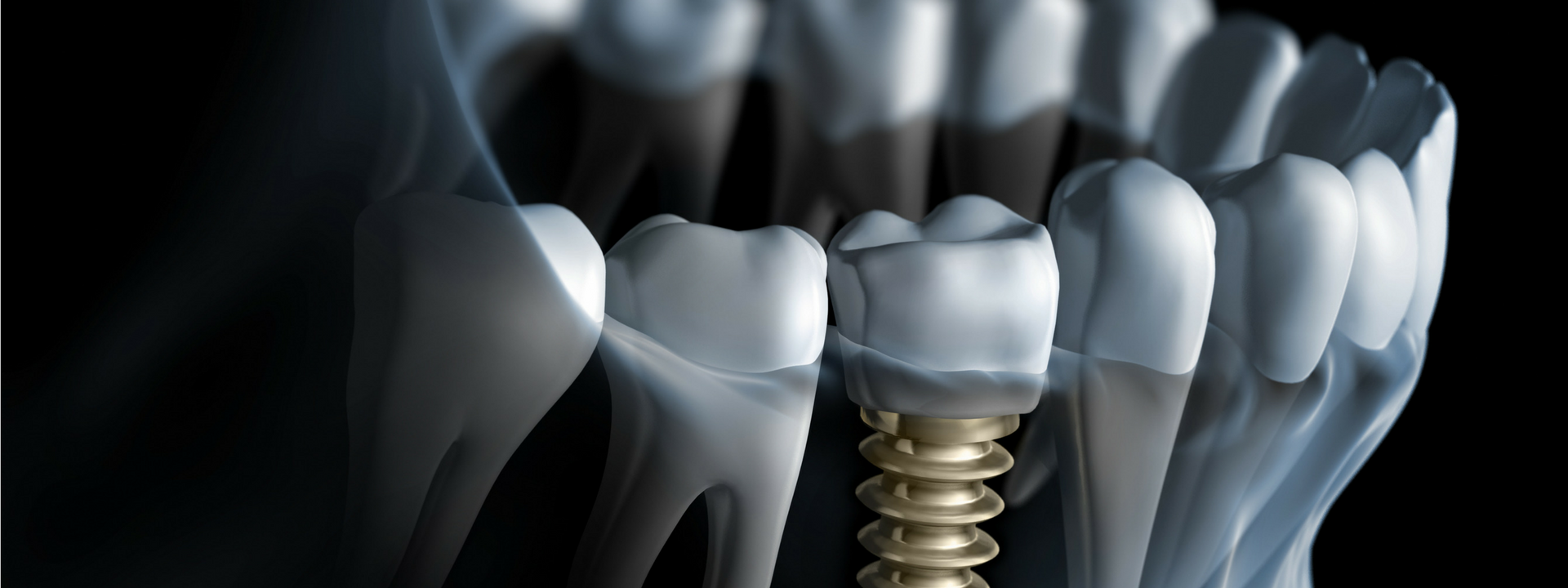 What is a reasonable price for dental implants?