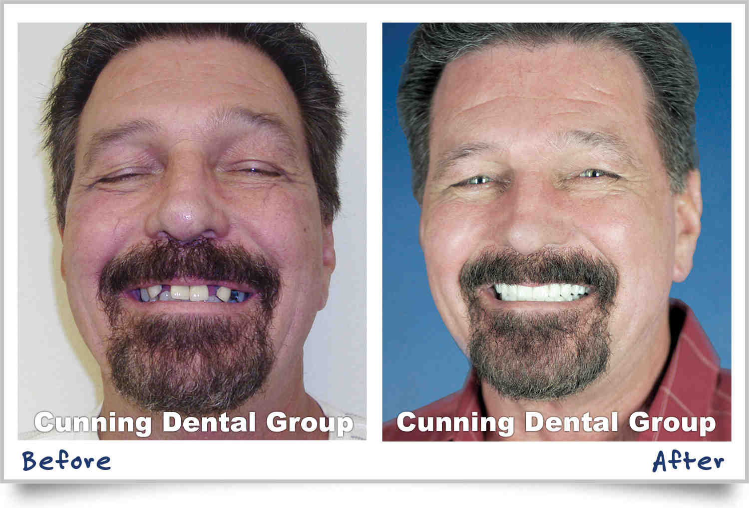 What is a reasonable price for dental implants?