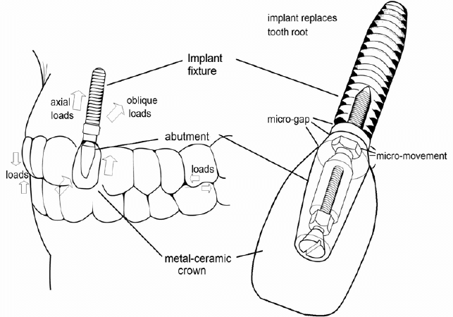 What is a reasonable price for dental implants?
