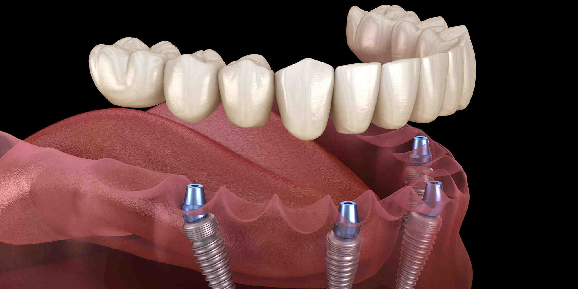What is a reasonable price for dental implants?