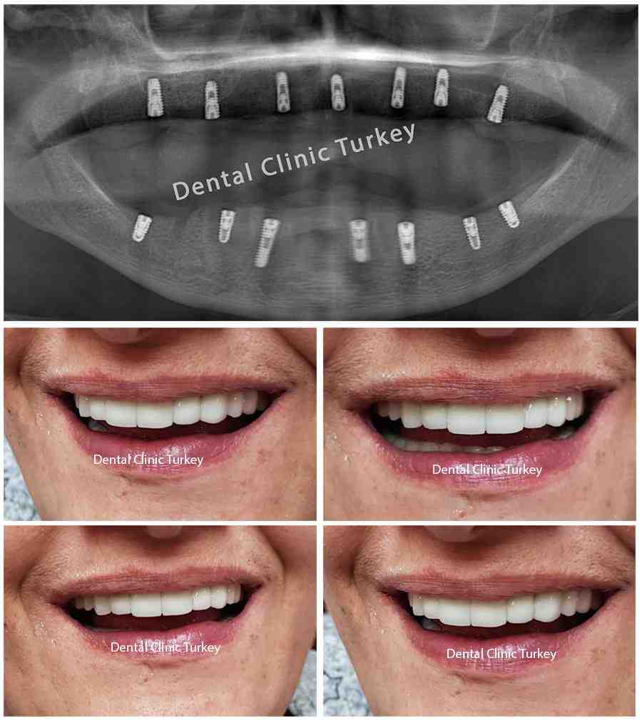What is a reasonable price for dental implants?