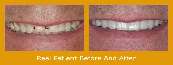 What is a reasonable price for dental implants?