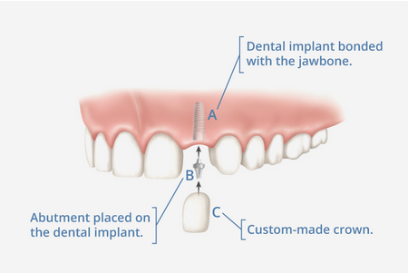 What is an implant specialist called?