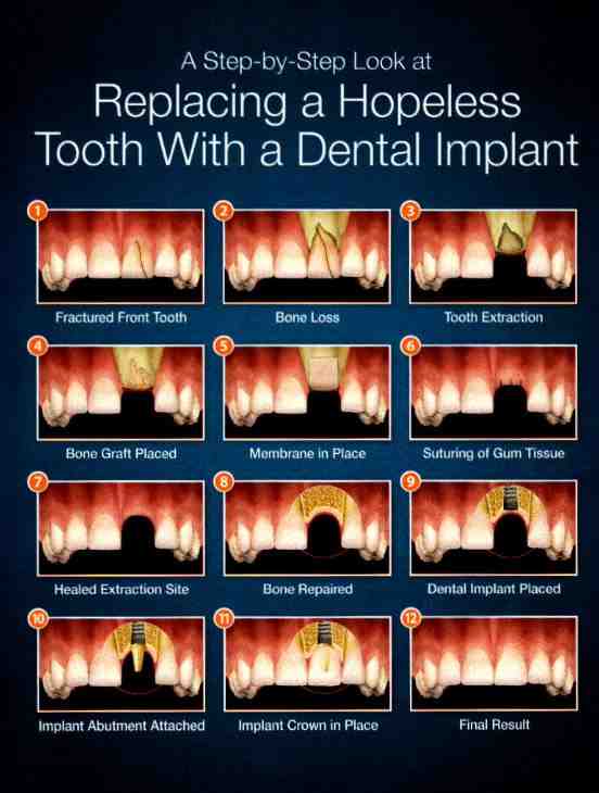 How to bone graft dental implants Dental News Network