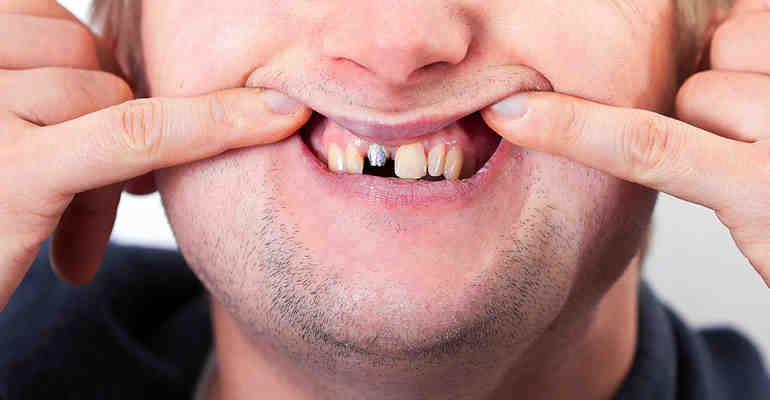 What is the average age for dental implants?