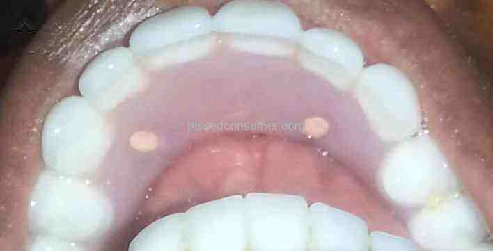 What is the average cost for full mouth implants?