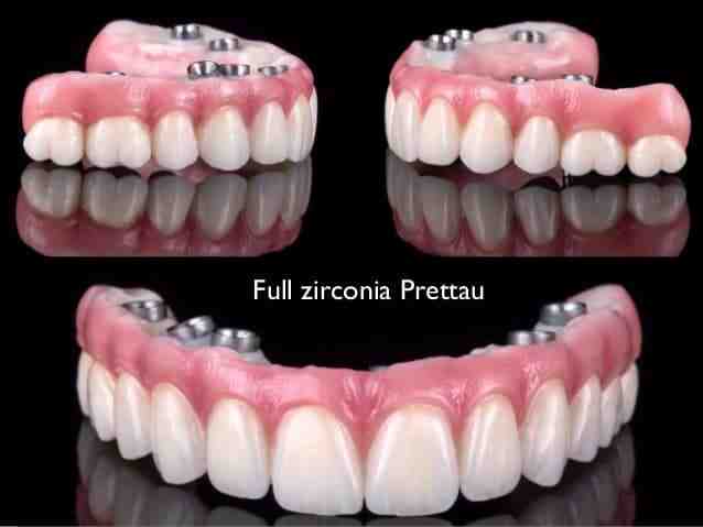 What is the average cost for full mouth implants?