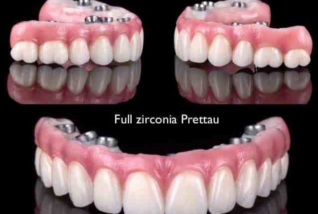 What is the average cost of full upper and lower dental implants