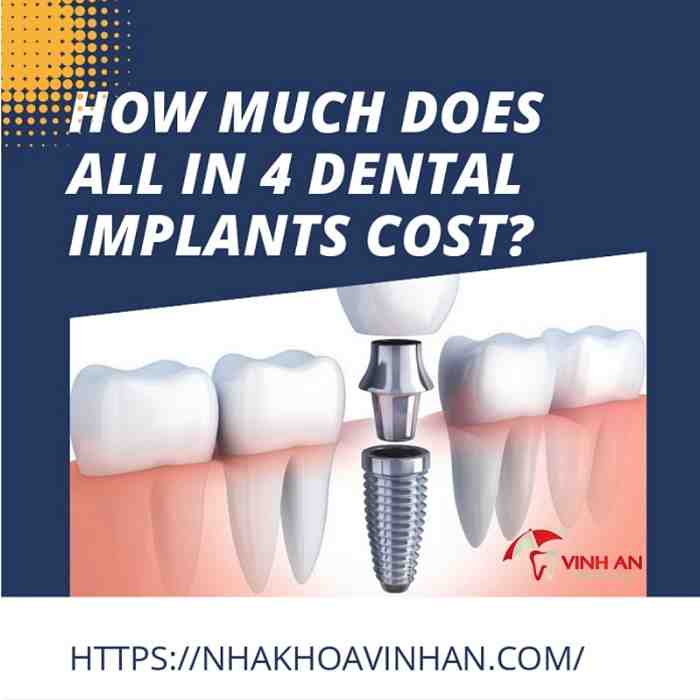 What is the average price for full mouth dental implants?