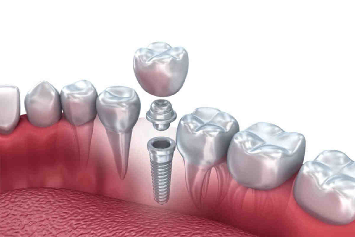 What is the average price for full mouth dental implants?