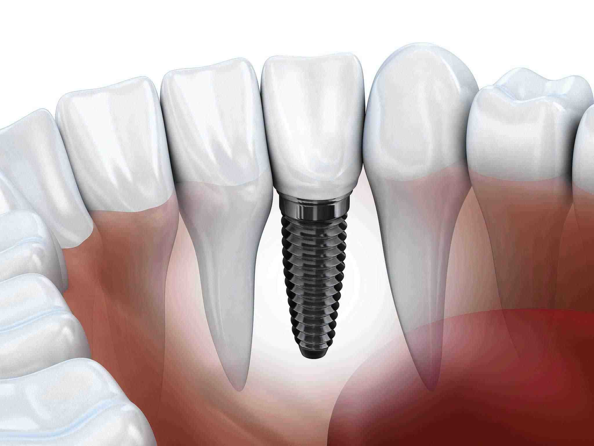 What does the average dental implant cost Dental News Network